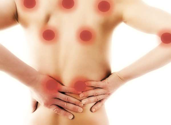 Che cos’è la fibromalgia