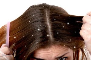Come prevenire la forfora in inverno