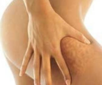 I cibi che causano la cellulite
