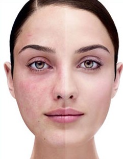 Che cos’è la rosacea?