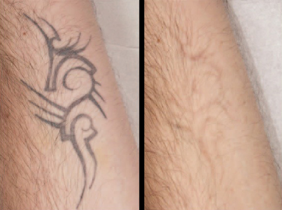 Come rimuovere un tatuaggio