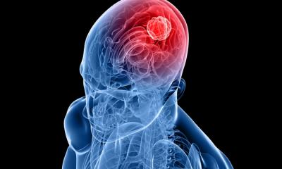 Percentuale sopravvivenza tumore al cervello