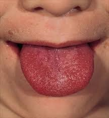scarlattina incubazione