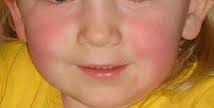 scarlattina bambini 2 anni