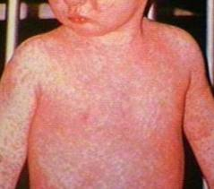 scarlattina bambini senza febbre