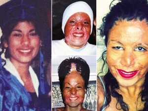 Si brucia la faccia con una candela, dal dramma ad una nuova vita Si brucia la faccia con una candela, dal dramma ad una nuova vita