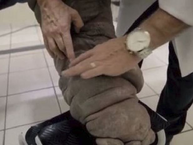 puntura di zanzare