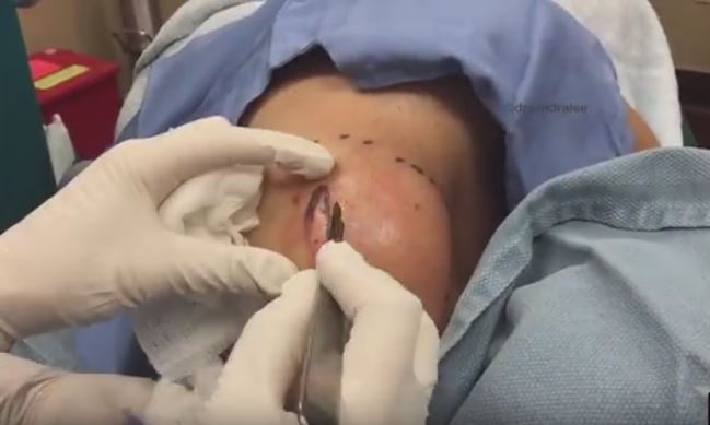 rimuove un enorme lipoma