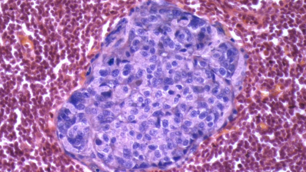 La cellula kamikaze CAR - T, ultima innovazione medica nella cura dei tumori del sangue La cellula kamikaze CAR - T, ultima innovazione medica nella cura dei tumori del sangue