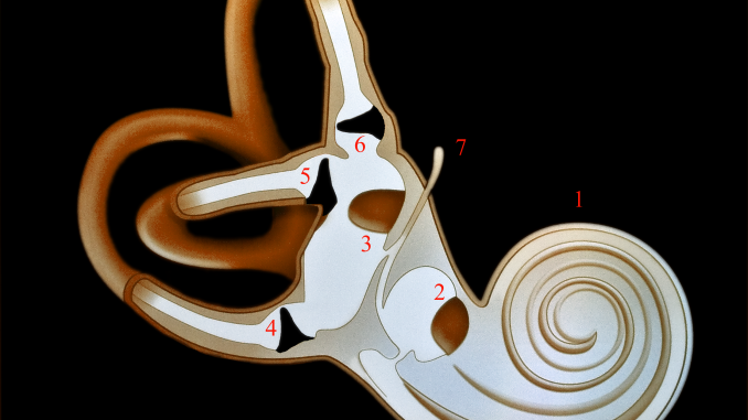 Artrosi Cervicale e Sindrome di Meniere Artrosi Cervicale e Sindrome di Meniere