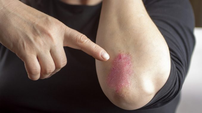 Psoriasi Guttata