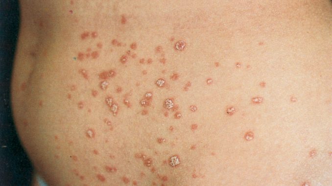 Psoriasi Guttata i rimedi biologici Psoriasi Guttata: i rimedi biologici