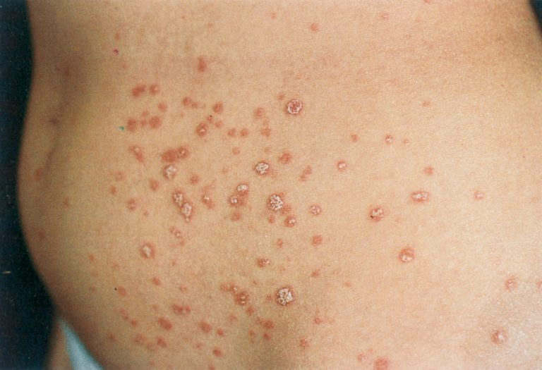 Psoriasi Guttata i rimedi biologici Psoriasi Guttata: i rimedi biologici