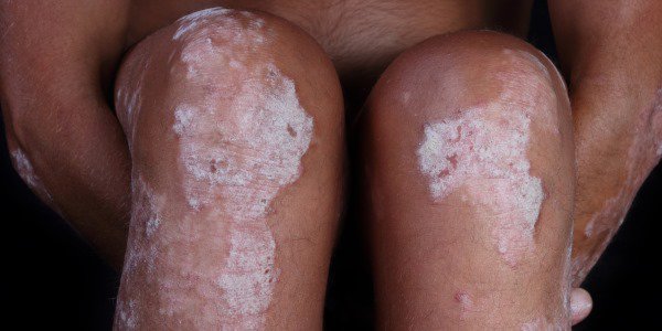 Psoriasi e le cause della sua apparizione Psoriasi e le cause della sua apparizione