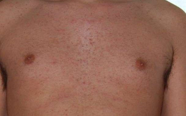 follicolite da depilazione cura e rimedi naturali follicolite da depilazione: cura e rimedi naturali