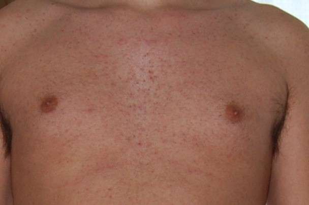 follicolite da depilazione cura e rimedi naturali follicolite da depilazione: cura e rimedi naturali