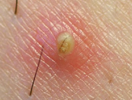pelo incarnito Causa ed eliminazione del pelo incarnito