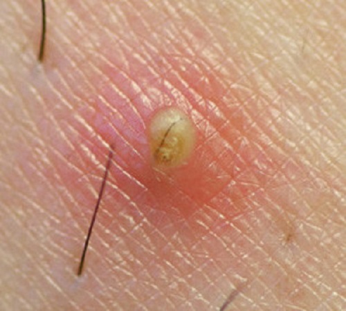 pelo incarnito Causa ed eliminazione del pelo incarnito