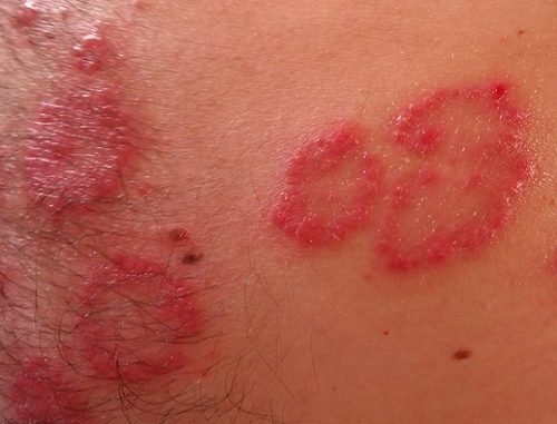 psoriasi Psoriasi: quali sono i primi sintomi