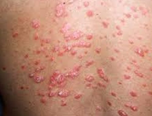 Risposte di advantan a dermatite atopic
