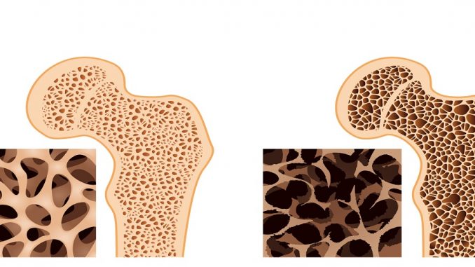 Osteoporosis