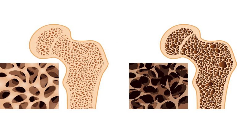 Osteoporosis