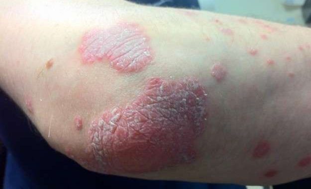La bioterapia: un nuovo rimedio per curare la psoriasi La bioterapia: un nuovo rimedio per curare la psoriasi