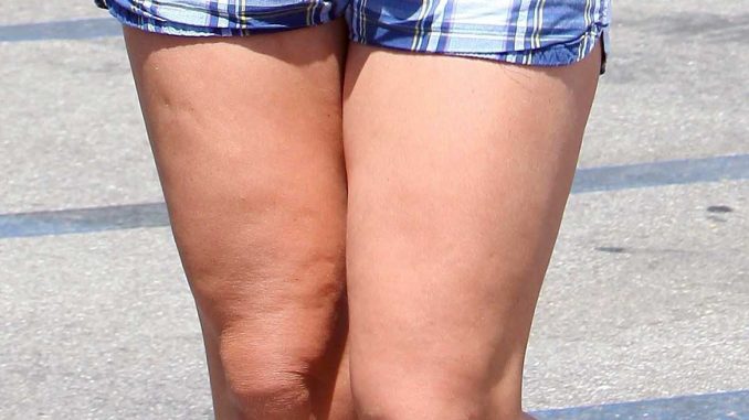 CELLULITE SULLE GINOCCHIA. CELLULITE SULLE GINOCCHIA.