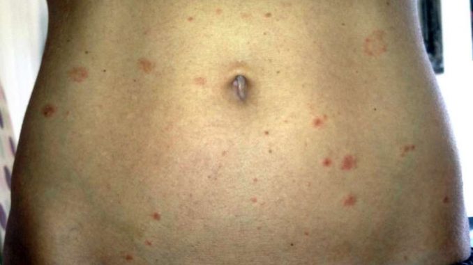 come-alleviare-prurito-micosi-sulla-schiena Come alleviare prurito micosi sulla schiena