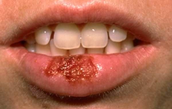 periodo-guarigione-di-herpes-labiale Periodo guarigione di herpes labiale