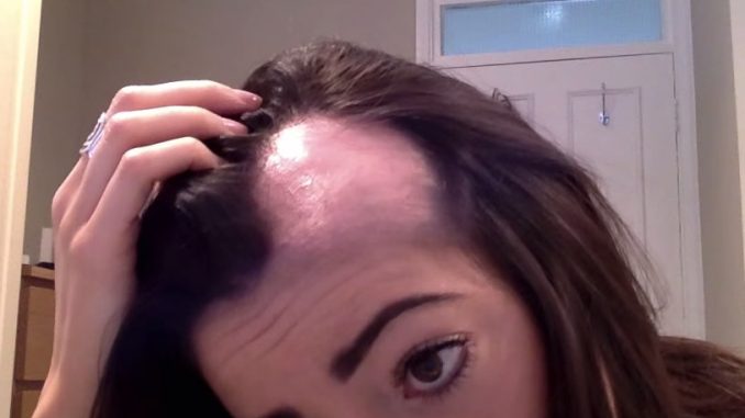 alopecia_femenina alopecia androgenetica