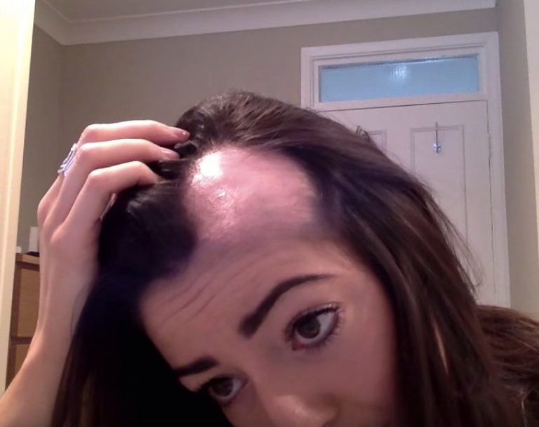 alopecia_femenina alopecia androgenetica