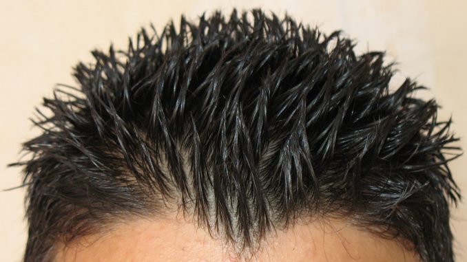 alopecia seborroica: ricrescita, sintomi, rimedi naturali alopecia