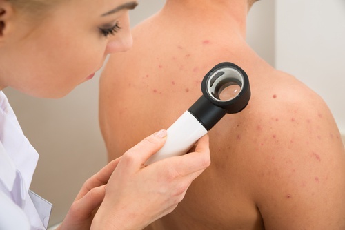 Brufoli sulla schiena: potrebbe essere colpa dell'ammorbidente Brufoli sulla schiena: potrebbe essere colpa dell'ammorbidente
