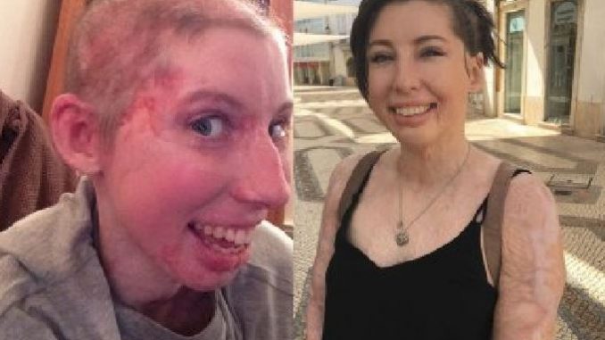 ragazzina-ustionata-in-un-incidente