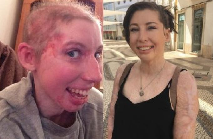 ragazzina-ustionata-in-un-incidente