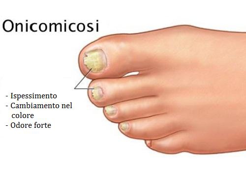 Micosi unghie ai piedi: rimedi con bicarbonato