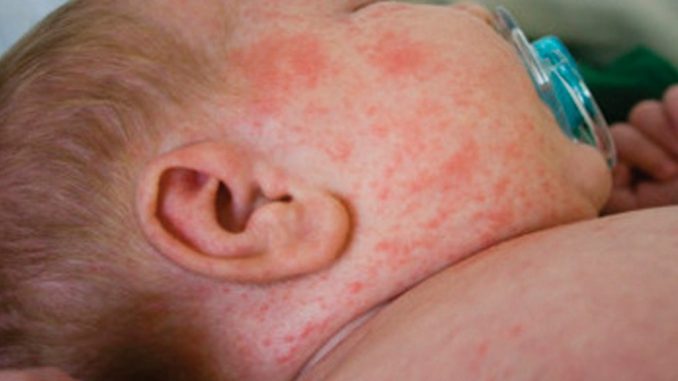 Epidemia morbillo: 6 morti, tutti bambini morbillo