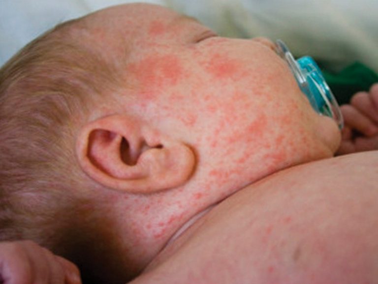 Epidemia morbillo: 6 morti, tutti bambini morbillo