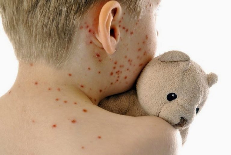 Morbillo: 400 bambini morti al giorno, solo vaccino può salvarli morbillo