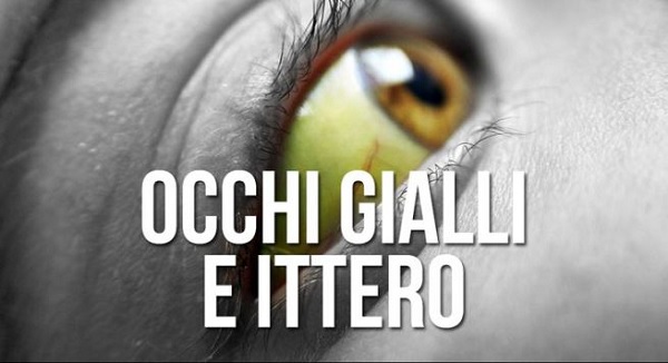 ittero-occhi-gialli-bambini-cause-e-cure ittero