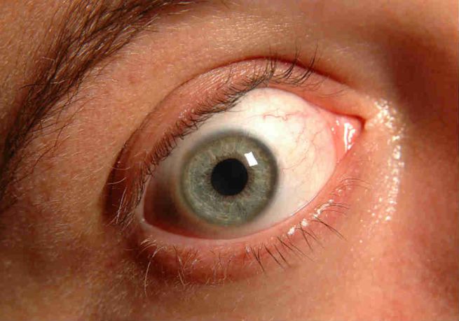glaucoma