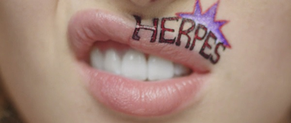 Herpes-labiale-come-sconfiggerlo-in-modo-naturale herpes labiale