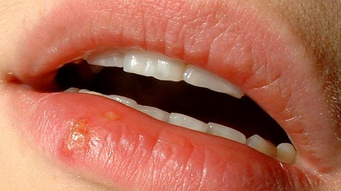 herpes-labiale-quanto-dura-e-farmaci-per-curarlo herpes labiale
