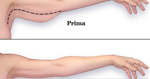 Come eliminare il grasso delle braccia: metodi semplici Come eliminare il grasso delle braccia: metodi semplici