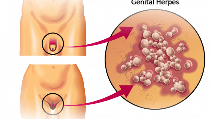 Herpes genitale: cause, sintomi e conseguenze Herpes genitale: cause, sintomi e conseguenze