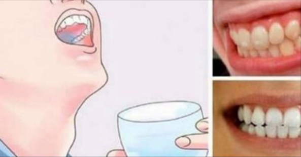Come eliminare placca e tartaro con semplici metodi: miscela fai da te Come eliminare placca e tartaro con semplici metodi: miscela fai da te