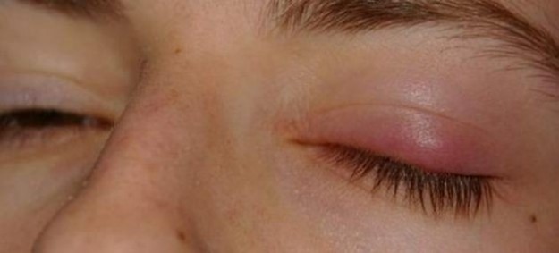 Orzaiolo: rimedi e cura naturale