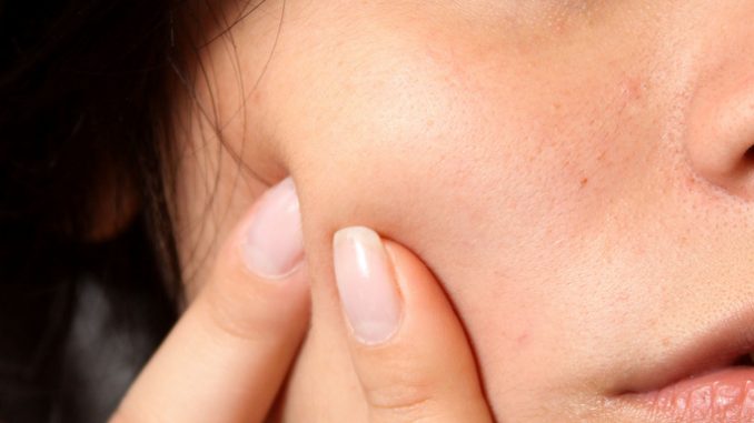 combattere-l'-acne-con-il-limone combattere