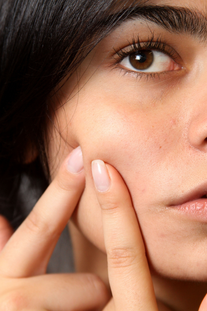 combattere-l'-acne-con-il-limone combattere